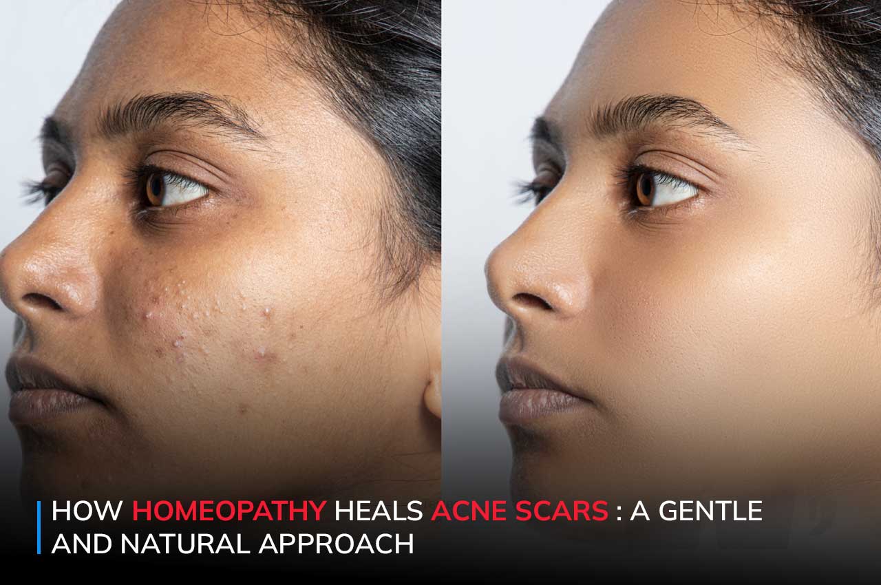 How Homeopathy Heals Acne Scars A Gentle and Natural Approach